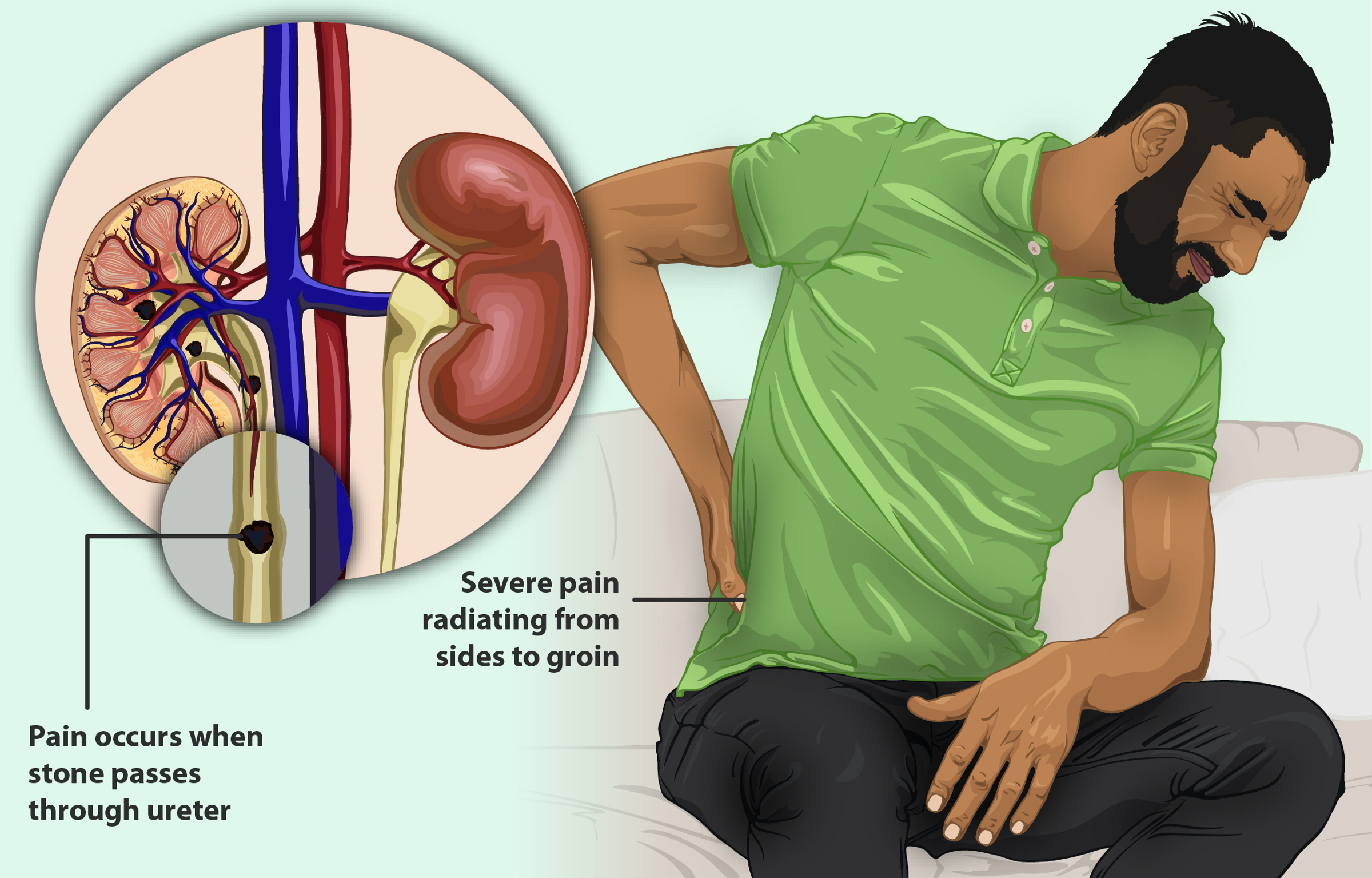 Kidney Stone — Symptoms, Causes and Treatment