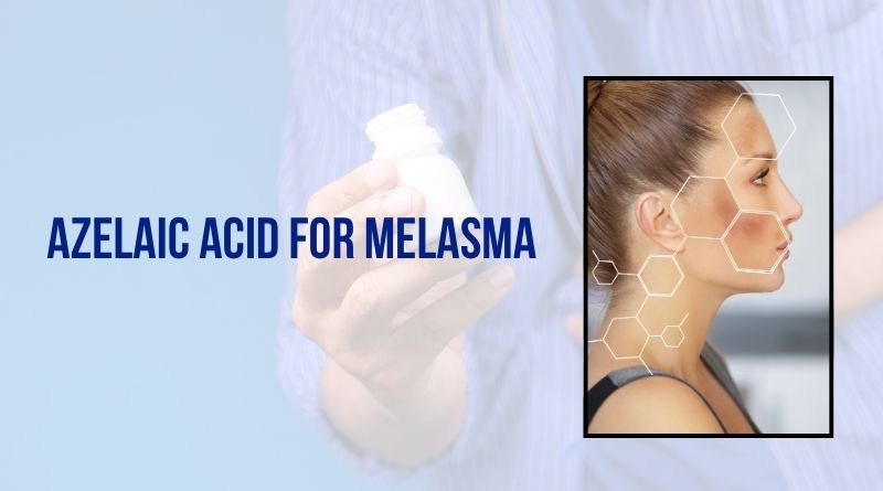 azelaic acid for melasma