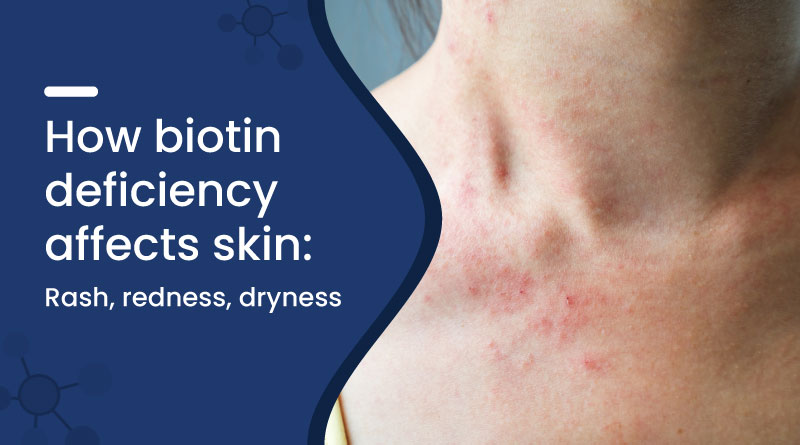 Biotin Deficiency Skin Symptoms Rash Redness Dryness Zeelab Pharmacy