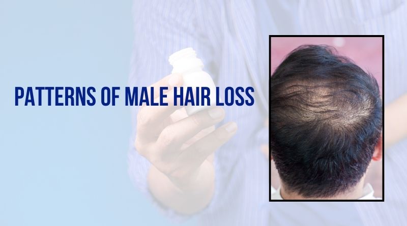 Patterns of Male Hair Loss