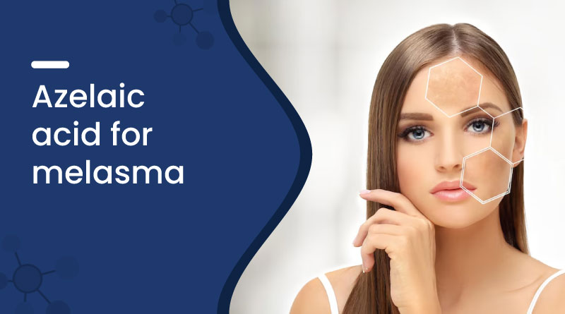 azelaic acid for melasma
