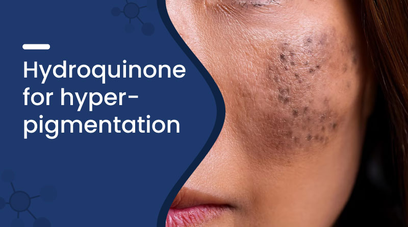 Hydroquinone For Hyperpigmentation