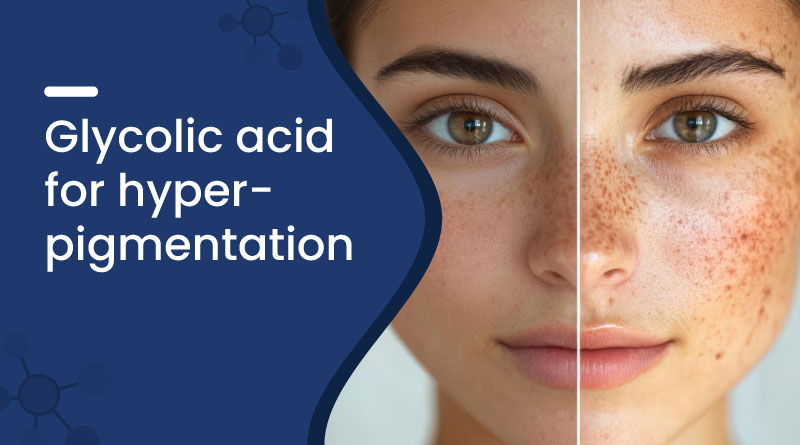 Glycolic Acid For Hyperpigmentation