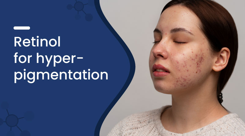 Retinol for Hyperpigmentation