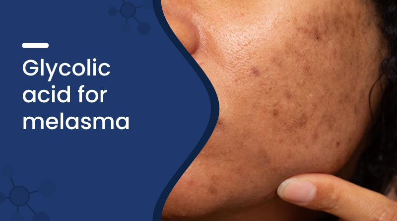 Glycolic Acid For Melasma