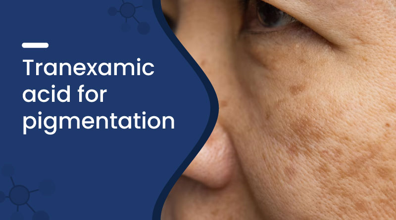 Tranexamic Acid For Pigmentation