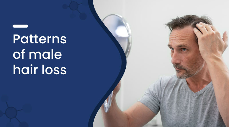Patterns of Male Hair Loss