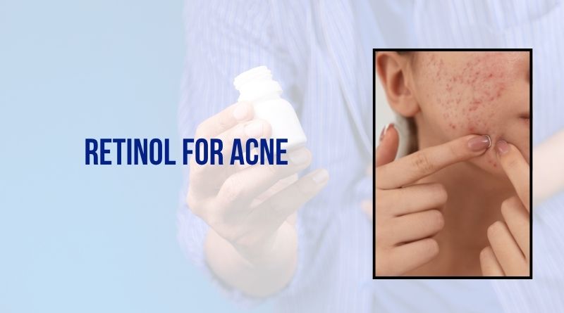 Retinol for Acne