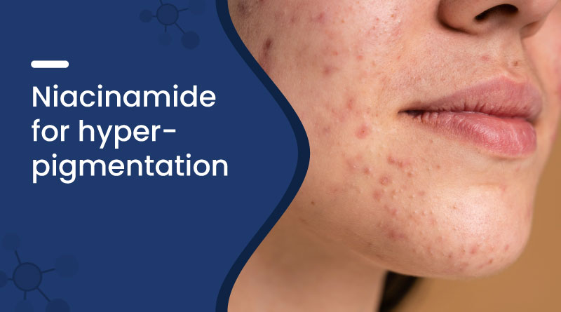 Niacinamide for Hyperpigmentation
