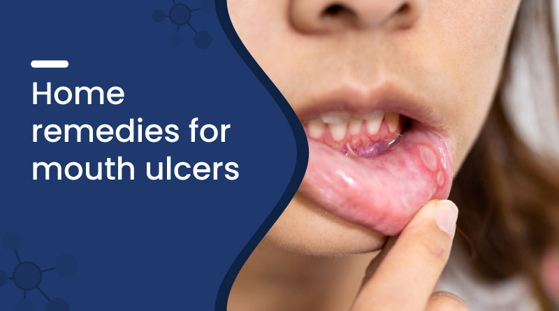 Home Remedies for Mouth Ulcers – Fast Relief with Natural Care