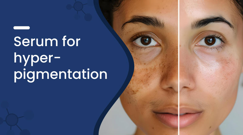 Best Serum for Hyperpigmentation – Fade Dark Spots Naturally