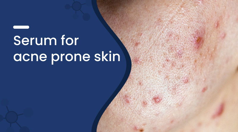 Best Serum for Acne Prone Skin – Control Breakouts Naturally