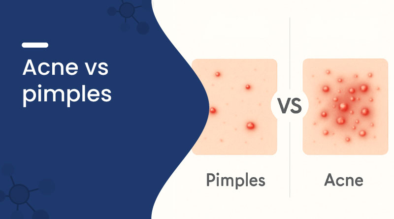 Acne vs Pimples 