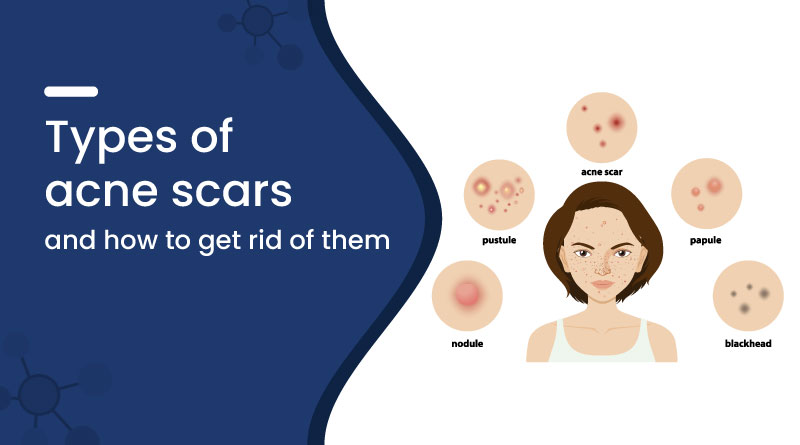 Types of Acne Scars (With Images), and How to Get Rid of Them