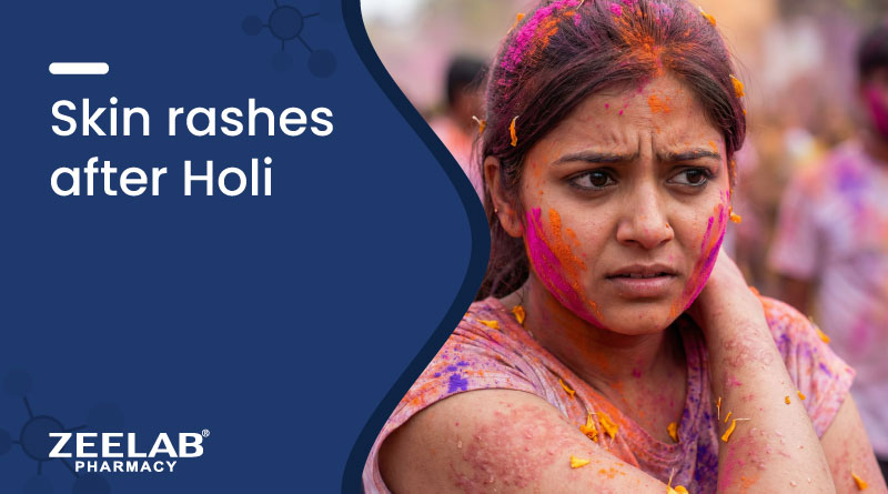Image of Skin Rashes After Holi