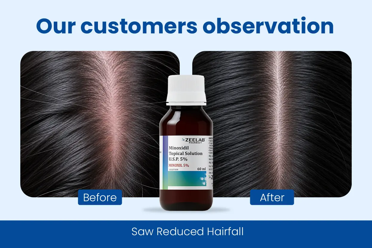 minoxil 5 topical solution before and after hair growth results