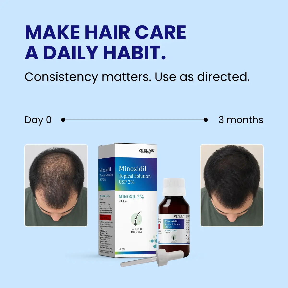 minoxil 2% topical solution for targeted scalp care
