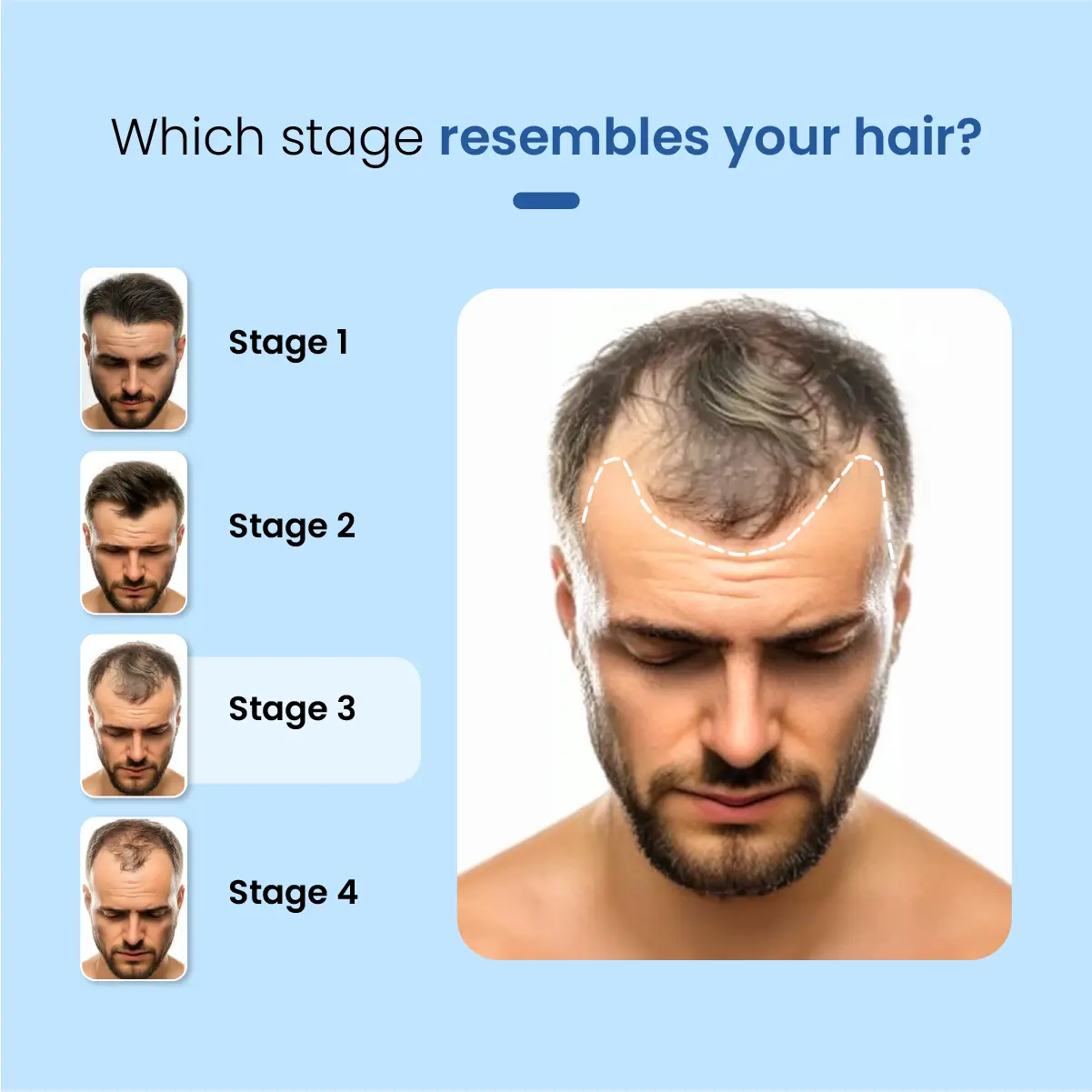 Minoxil F 5% Topical Solution | For Hair Growth