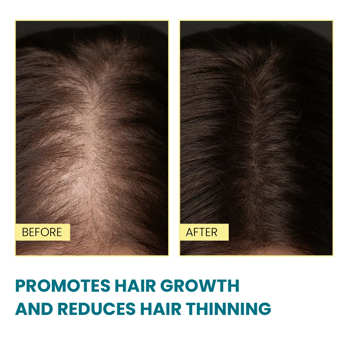 Minoxil Pro hair growth serum before after