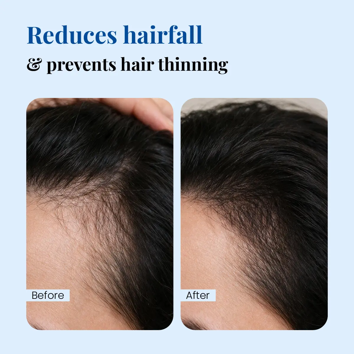 Minoxil 5% Topical Solution hair fall before and after comparison