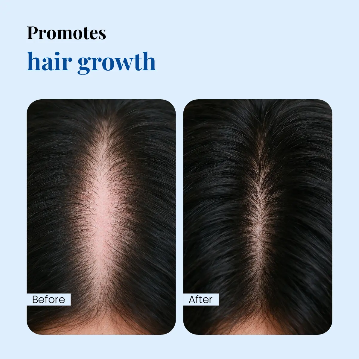 Minoxil 5% Topical Solution hair growth before and after comparison